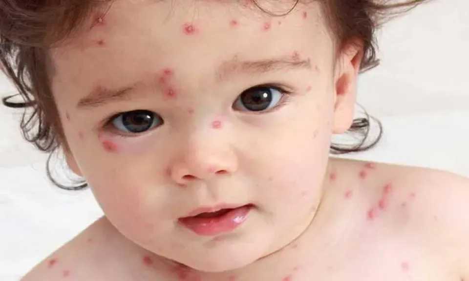 الرعب يجتاح بريطانيا بعد انتشار مرض قاتل بين الأطفال في لندن.. ما هو؟ الرعب يجتاح بريطانيا بعد انتشار مرض قاتل بين الأطفال في لندن.. ما هو؟