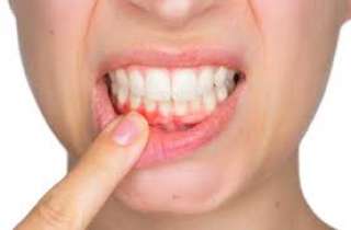 طرق علاج التهاب اللثة في...