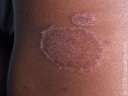 طرق علاج فطريات الجسم
