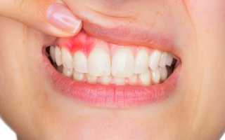 طرق علاج التهاب اللثة في...