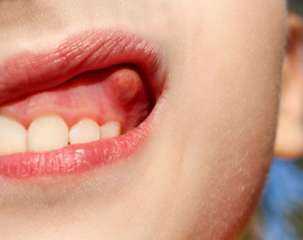 علاج خراج الأسنان بطرق طبيعية