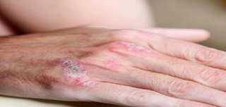 أعشاب طبيعية لعلاج الصدفية