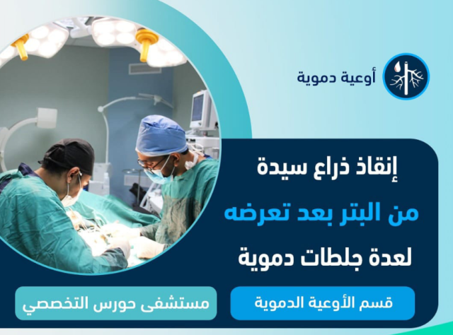 فريق طبى ينجح فى استئصال عدد من الجلطات بالذراع الأيسر لسيدة في الأربعين من عمرها