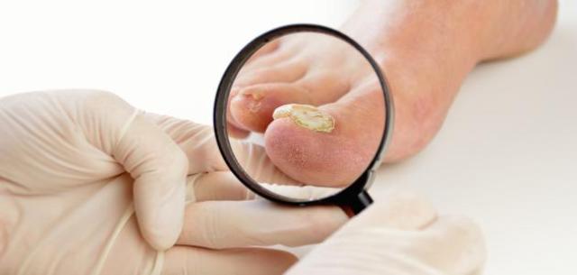 طرق علاج فطريات اصابع القدم في المنزل