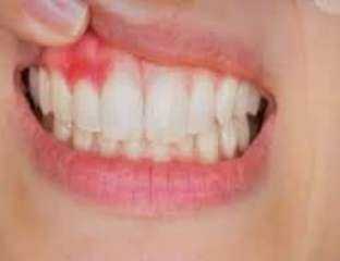 الفرق بين خراج اللثة وخراج...