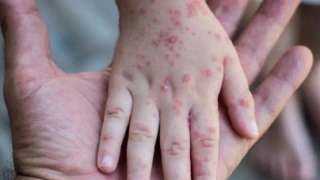 إيطاليا تسجل أكثر من 400...
