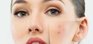 طرق التخلص من البثور
