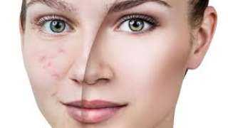 أهم الخطوات الأساسية لعلاج حب...