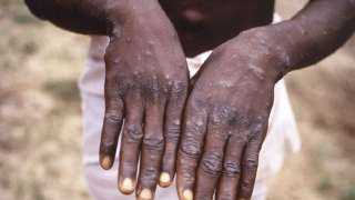 السودان: تسجيل 5 إصابات جديدة...