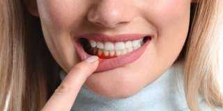 تعرفى على أبرز أمراض اللثة...