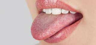 أعراض وعلاج الفطريات بالفم