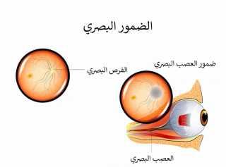 ضمور العصب البصري: طرق علاج...