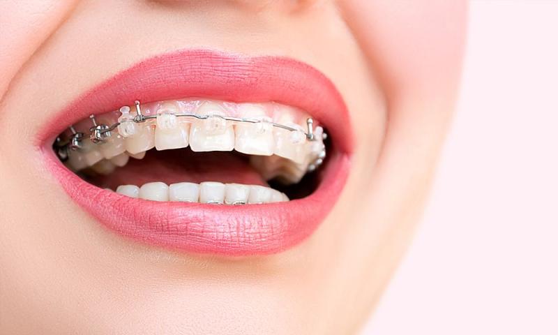اسعار تقويم الاسنان