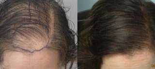 نستعرض شروط زراعة الشعر