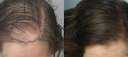 نستعرض شروط زراعة الشعر