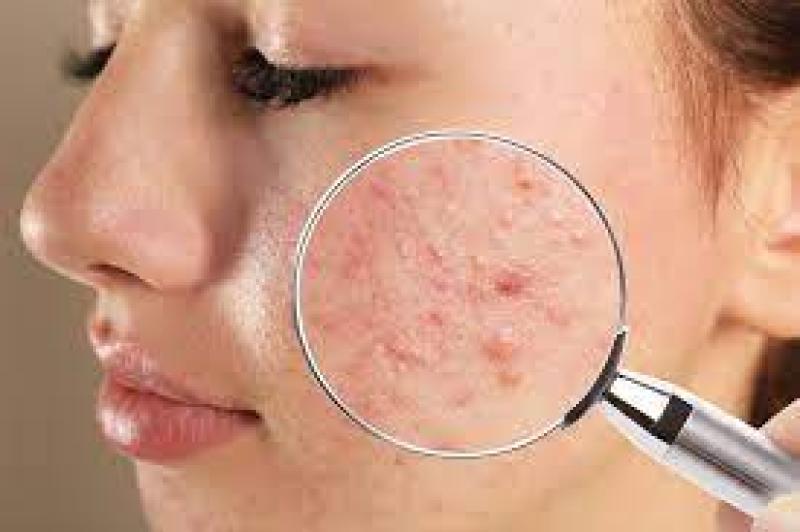 طرق الوقايه من حب الشباب