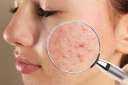 طرق الوقايه من حب الشباب