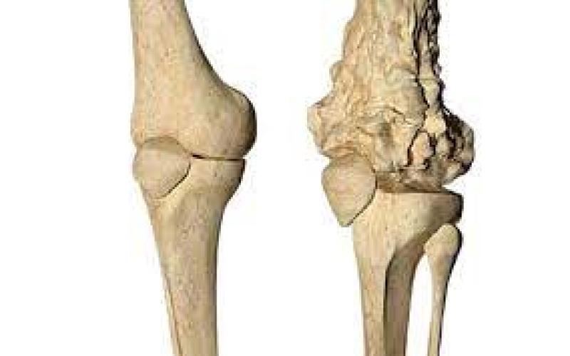 الساركوما الغضروفية