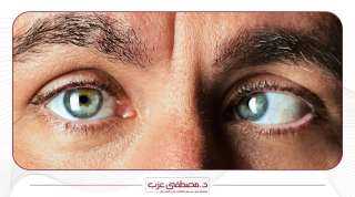 حول العين| أسبابه و4 طرق...