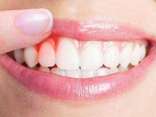 6 أفضل علاجات منزلية فعالة...
