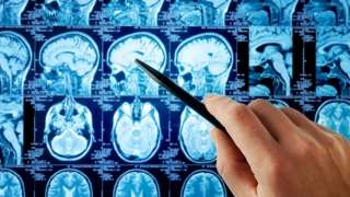 اكتشاف علاج محتمل لوقف نمو...