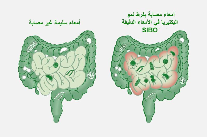 هل الانتفاخ المستمر مجرد عرض؟ تعرف على علامات اضطراب البكتيريا الخفي