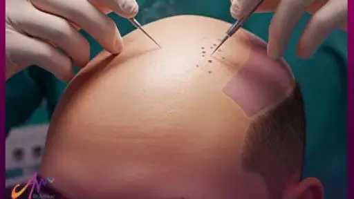 افضل تقنيات زراعة الشعر في...