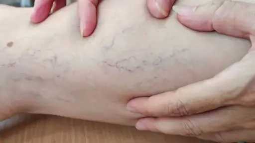 دراسة تؤكد تأثير الدوالي على...