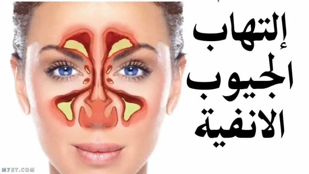 لا تتجاهل التهاب الجيوب الأنفية : أعراض بسيطة قد تخفي مضاعفات خطيرة تستدعي العلاج